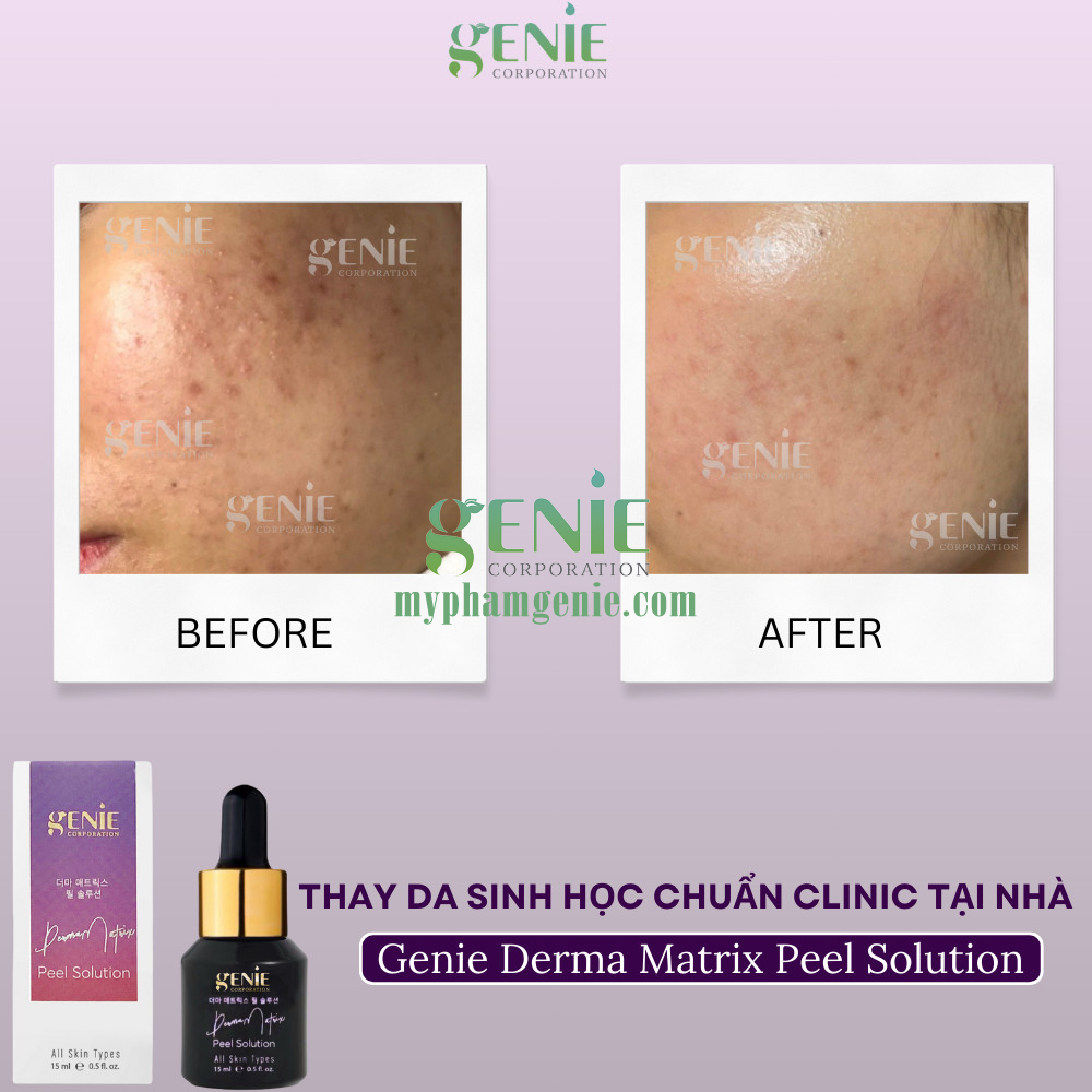 peel da là gì peel da là gì