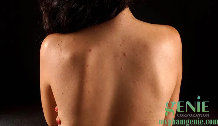 cách trị mụn lưng