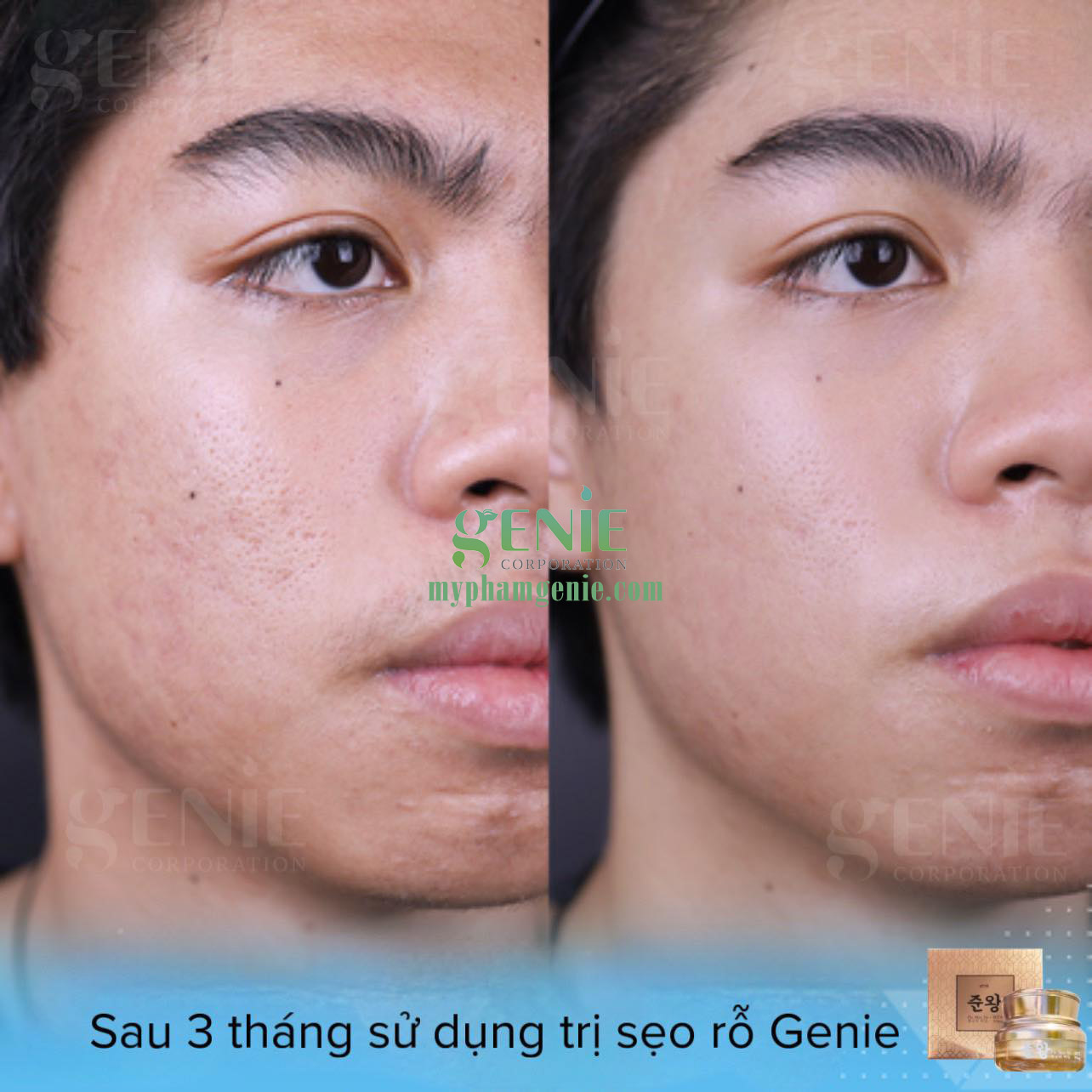 cách trị sẹo rỗ