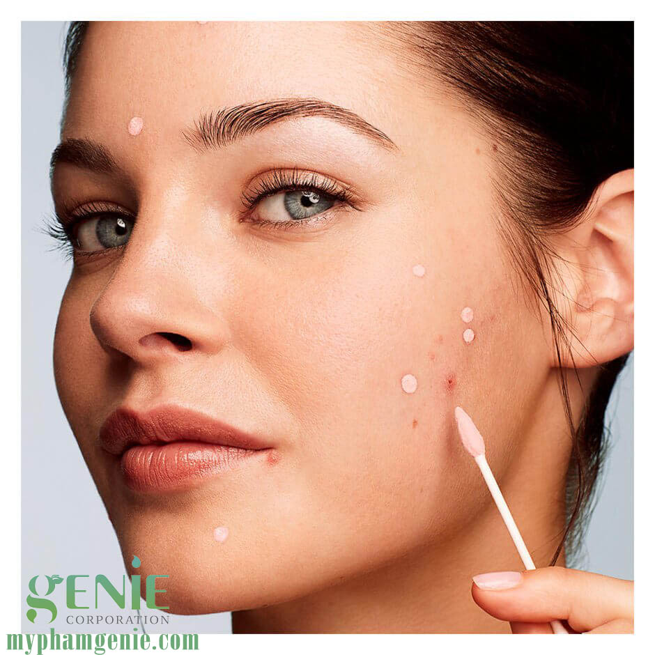 review serum trị mụn hàn quốc sos acnes genie